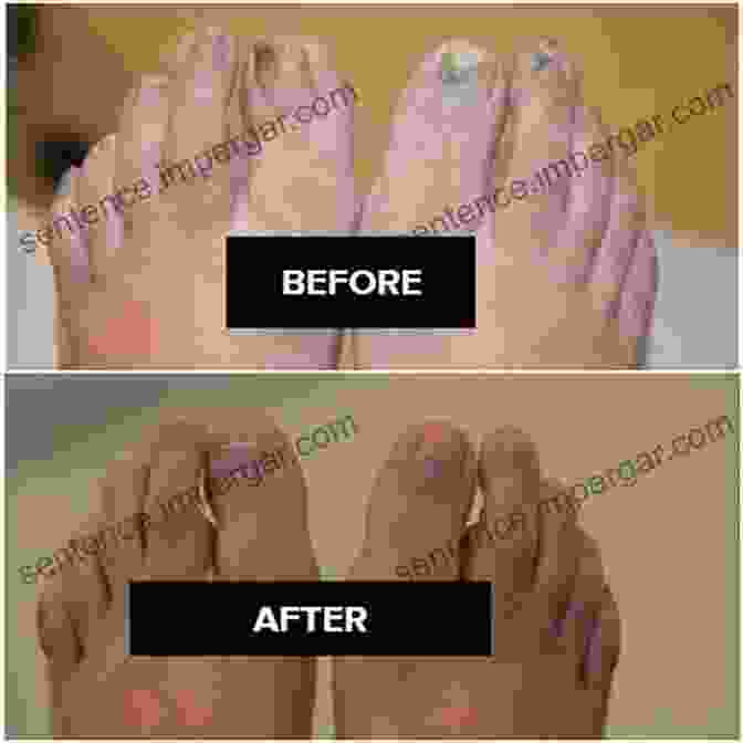 Before And After Images Of Nail Fungus Treatment How To Get Rid Of Nail Fungus